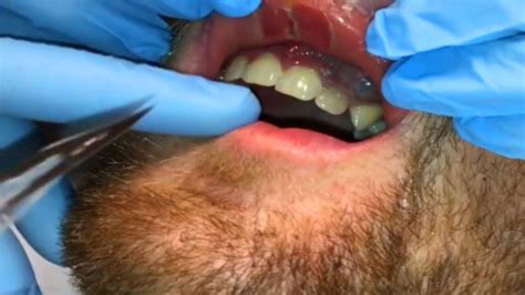 Gum Abscess Popped: A Quick Guide to Treatment and Relief